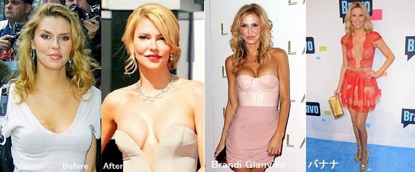 Implants_Brandi.jpg